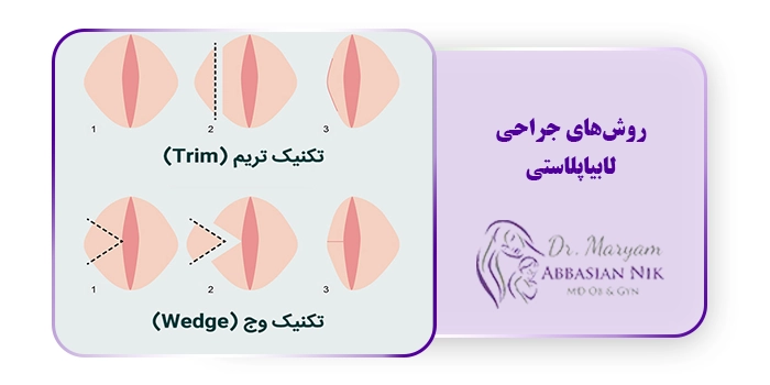 روش‌های جراحی لابیاپلاستی