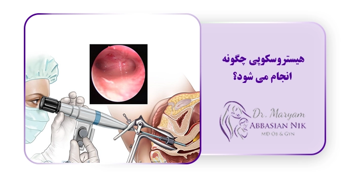 هیستروسکوپی چگونه انجام می شود؟