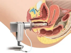 آر اف واژِینال