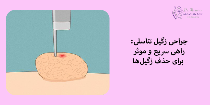 جراحی زگیل تناسلی