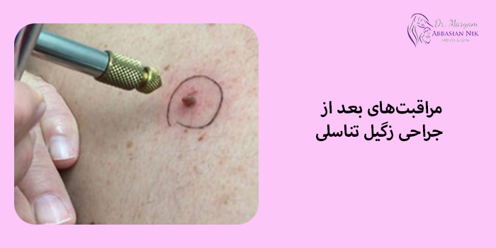 مراقبتهای بعد از جراحی زگیل تناسلی