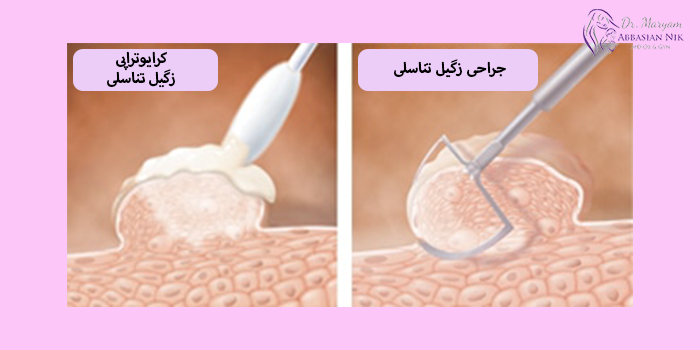 نحوه انجام کرایوتراپی زگیل تناسلی و مراقبت های بعد از آن