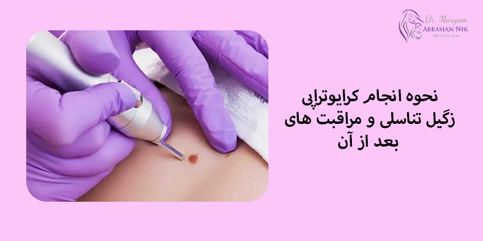مراقبت های بعد از کرایوتراپی زگیل تناسلی