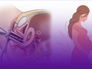 بارداری بعد از هیستروسکوپی